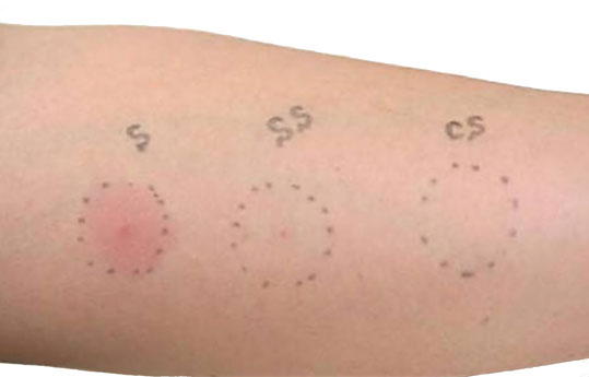 Résultats De prick test positifs (5).