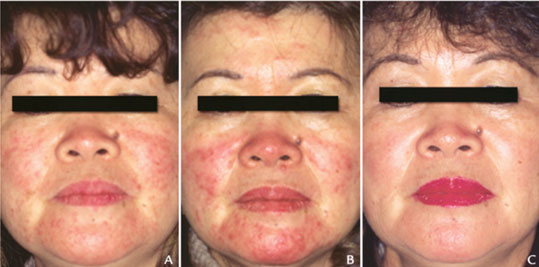 L’évolution de l’eczéma facial depuis la pose d’implant jusqu’à rémission complète après leur retrait (12).