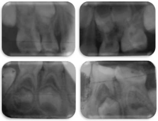 Bilan radiographique mettant en évidence l’atteinte pulpaire des 54,55, 65, 74,75 et 85. L’atteinte parodontale de la 84 avec résorption pathologique de la racine distale