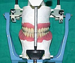 Montage de la prothèse mandibulaire sur articulateur.