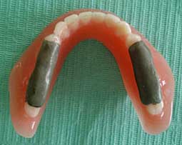 Fig 2 : Deux bandes de cire aluwax sont collées sur les dents postérieures. Deux bandes de cire aluwax sont collées sur les dents postérieures.