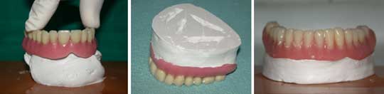 Réalisation des modèles maxillaire et mandibulaire en plâtre à prise rapide.