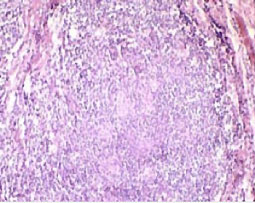 Chéilite granulomateuse des glandes salivaires accessoires : des granulomes dans le chorion superficiel, des foyers de cellules épithélioïdes entourés de lymphocytes (HE 10x).