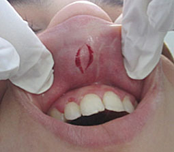 Biopsie de la lèvre supérieure 