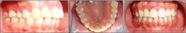 Situation initiale : la 11 et 12 présentent des provisoires. Noter une légère inflammation de la gencive marginale en regard de ces deux dents.