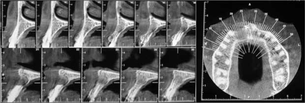 Examen Cone Beam réalisé 6 mois après la chirurgie endodontique montrant la réorganisation osseuse.