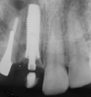 Radiographie rétroalvéolaire de contrôle en post-chirurgie et après transvissage de la provisoire montrant une bonne position tridimensionnelle de l’implant, et aussi la réduction du volume de la lésion périapicale en regard de la 12. Noter la longueur de l’implant qui est de 14mm.