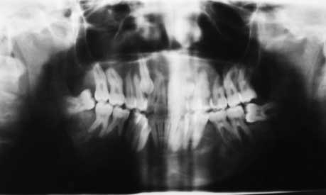 Radiographie panoramique montrant deux images radio-claires, bien limitées. 