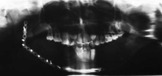 Aspect en radiographie panoramique après résection et  reconstruction avec maxiplaque et greffon costal sur le côté droit et énucléation-résection du fibrome du côté gauche.