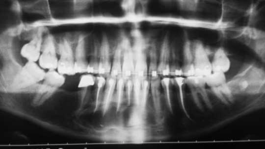 Radiographie panoramique montrant une image ostéolytique bien limitée avec une composante radio-opaque à la gauche de la lésion.