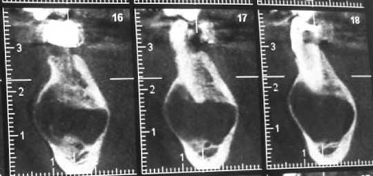 Un orthopantomogramme montrant une lacune symphysaire et parasymphysaire droite.