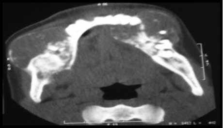 Tomodensitométrie en coupe axiale montrant deux processus tumoraux hétérogènes au niveau de l’angle mandibulaire droit et la branche horizontale du côté gauche, avec amincissement et rupture de la  corticale osseuse.