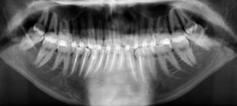 Radiographie  de contrôle à 2 ans.