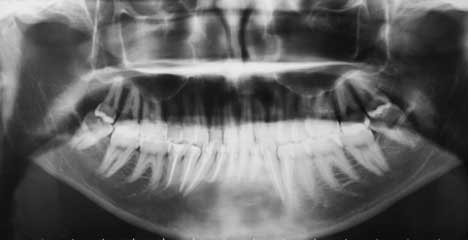 Radiographie  de contrôle à 6 mois.