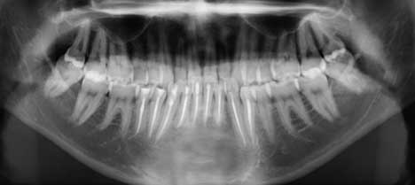 Radiographie  de contrôle à 1 an.