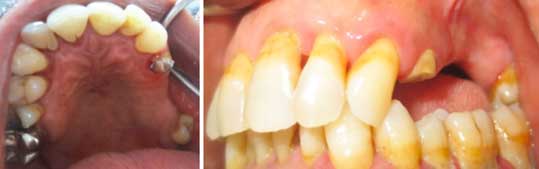 Vue de l’édentement maxillaire bordé par la 24 à l’état de racine opposé à une mandibule complètement dentée.
