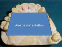 La conception prothétique se trouve à l’intérieur du polygone de sustentation.