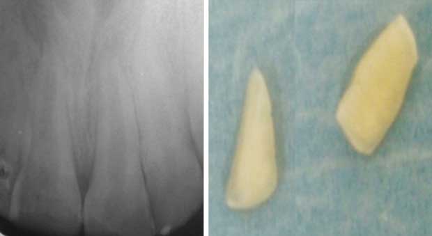 Rétro alvéolaire des dents concernées par le traumatisme et les deux fragments coronaires.