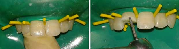 Adaptation du fragment et réalisation du chanfrein externe.