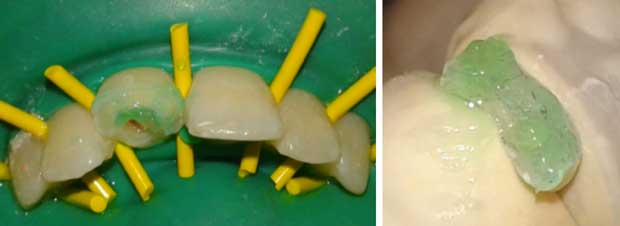 Mordançage dent et fragment pendant 30 secondes à l’acide ortho phosphorique.