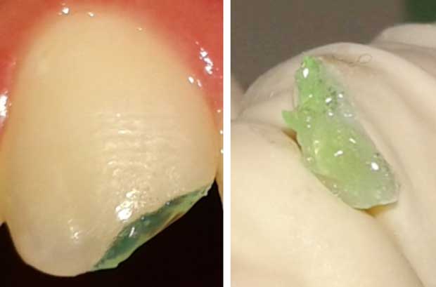 Mordançage de la dent et du fragment à l’acide ortho phosphorique à 37% pendant 30 secondes.