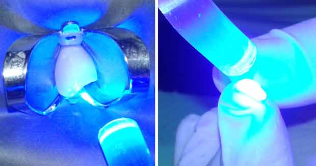 Photopolymérisation de l’adhésif sur la dent et le fragment pendant 40 secondes.