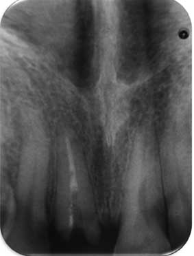 Radiographie pré-opératoire.