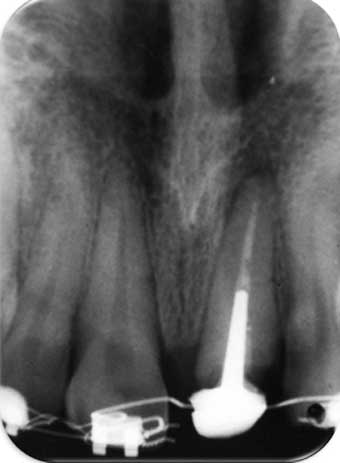 Radiographie de contrôle (après 3 semaines).