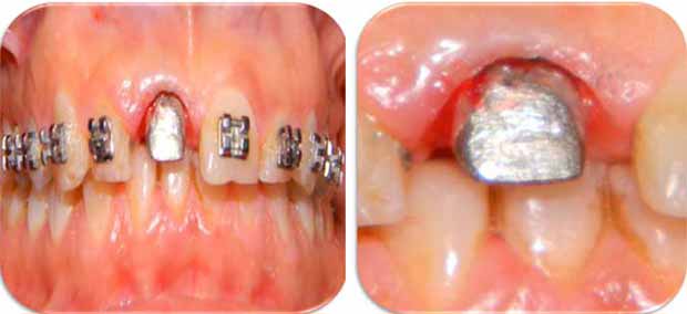 Élimination de l’éperon vestibulaire + gingivoplastie.