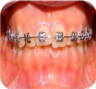 Stabilisation par un arc 018x 025 (prothèse provisoire en place).