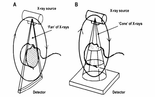 A: TDM, avec empilement de coupes. B: CBCT avec reconstitution d’un volume