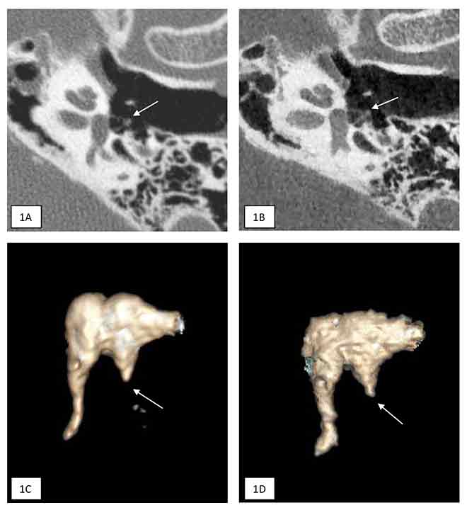 Fig 6 : 1A. TDM, 1B. CBCT : coupe axiale du rocher gauche. Longue apophyse de l’enclume non visible, zone de vacuité en regard du bouton de l’étrier (flèches). 1C. TDM, 1D. CBCT : reconstruction 3D. Lyse de la longue apophyse de l’enclume (flèches).