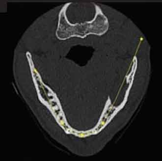 secció axial que mostra una lisi de la taula interna de la branca horitzontal mandibular (CBCT).