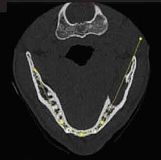 Coupe axiale montrant une lyse de la table interne de la branche horizontale mandibulaire (CBCT).