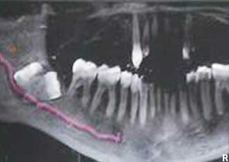 Coupe panoramique matérialisant la trajectoire du nerf alvéolaire inférieur droit et son rapport avec la 3ème molaire mandibulaire droit (CBCT).