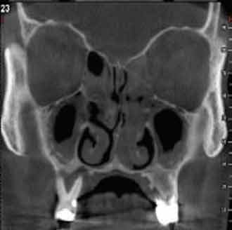 Coupe frontale montrant une pansinusite droite et gauche avec image radioclaire en regard de la molaire droite supérieure (CBCT).