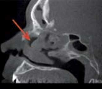 Coupe sagittale montrant un épaississement des muqueuses des fosses nasales (flèche orange) , sinus frontal et sinus sphénoïdal (CBCT).