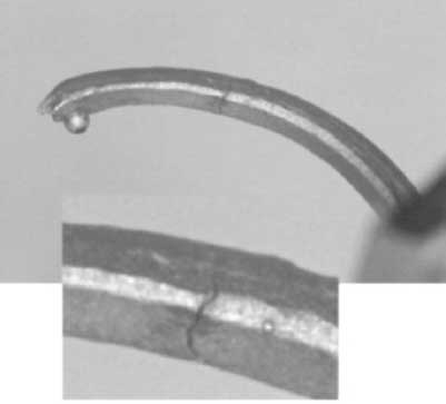Fracture d’un crochet Co-Cr par fatigue sous une déformation de 0,5mm.
