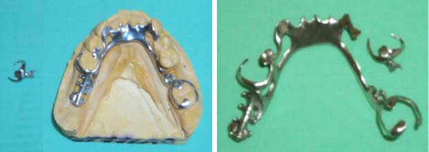 Fracture au niveau de la zone de raccordement entre potence et selle prothétique. Fracture au niveau de la zone de raccordement entre potence et selle prothétique.