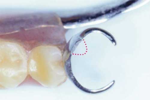 Fracture de l’appui occlusal