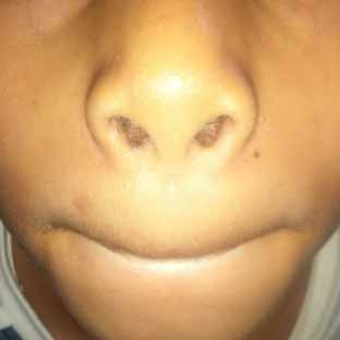 Orifice cutané de la fistule médiane congénitale de la lèvre supérieure centré sur le sillon naso-labial.