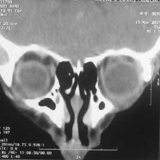 Scanner du massif facial montre la petite collection sous-cutanée médiane, en regard de la lèvre supérieure.