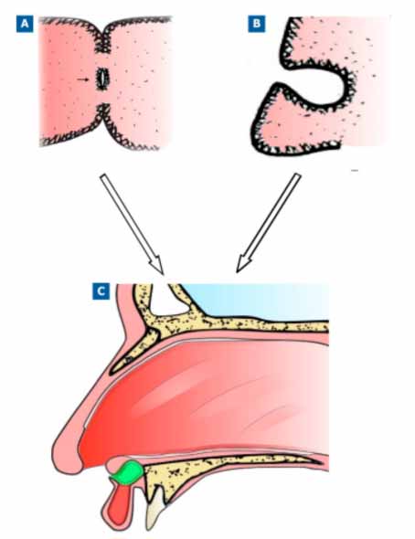 Théories sur l’embryopathogénie des kystes et fistules de la lèvre supérieure.