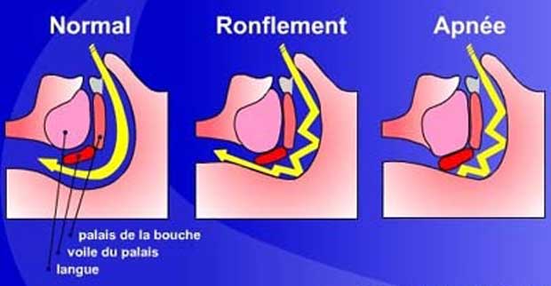 causes du renflement et de l'apnée du sommeil