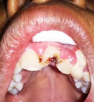 Fig 1 : Vue endobuccale montrant le trait de fracture atteignant la pulpe sur la 21. 