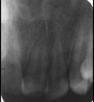 Fig 2 : Radiographie rétro-alvéolaire préopératoire objectivant la communication de la fracture avec la lumière canalaire.