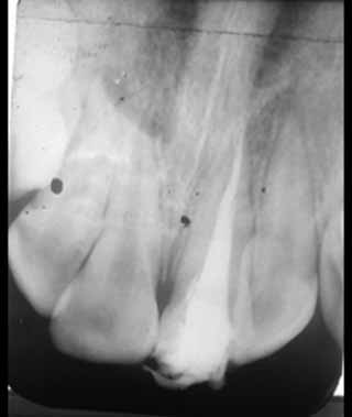 Fig 4 : Radiographie post-opératoire de l’obturation canalaire par technique de condensation latérale de la gutta à froid.