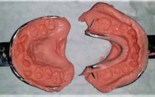 Fig 5 : Empreinte maxillaire et mandibulaire à l’alginate. 