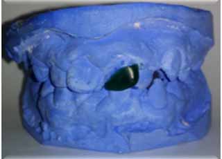 Fig 6 : Wax up par cire de diagnostic.