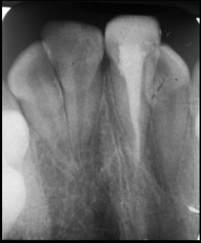 Fig 10 : Contrôle radiographique à 6 mois : disparition des résorptions et absence d’apparition de nouvelles lésions.